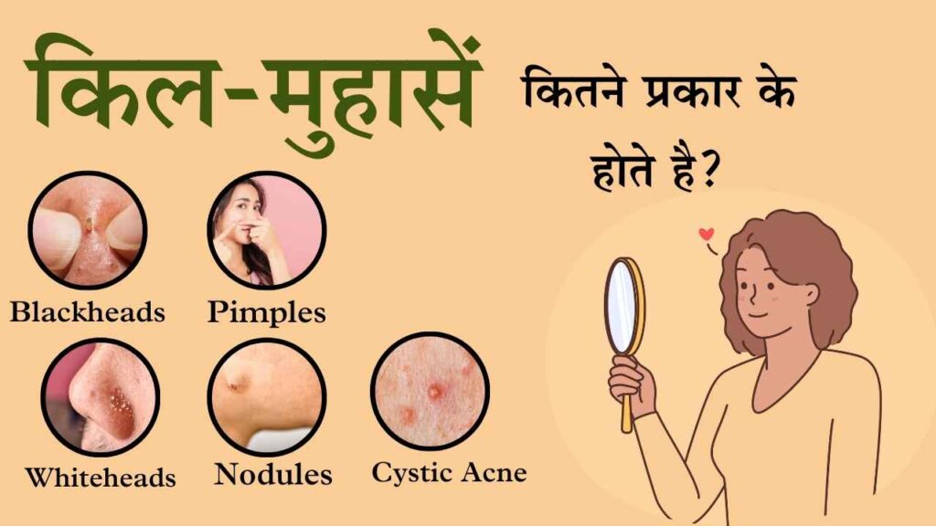 किल- मुहासे कितने प्रकार के होते है :