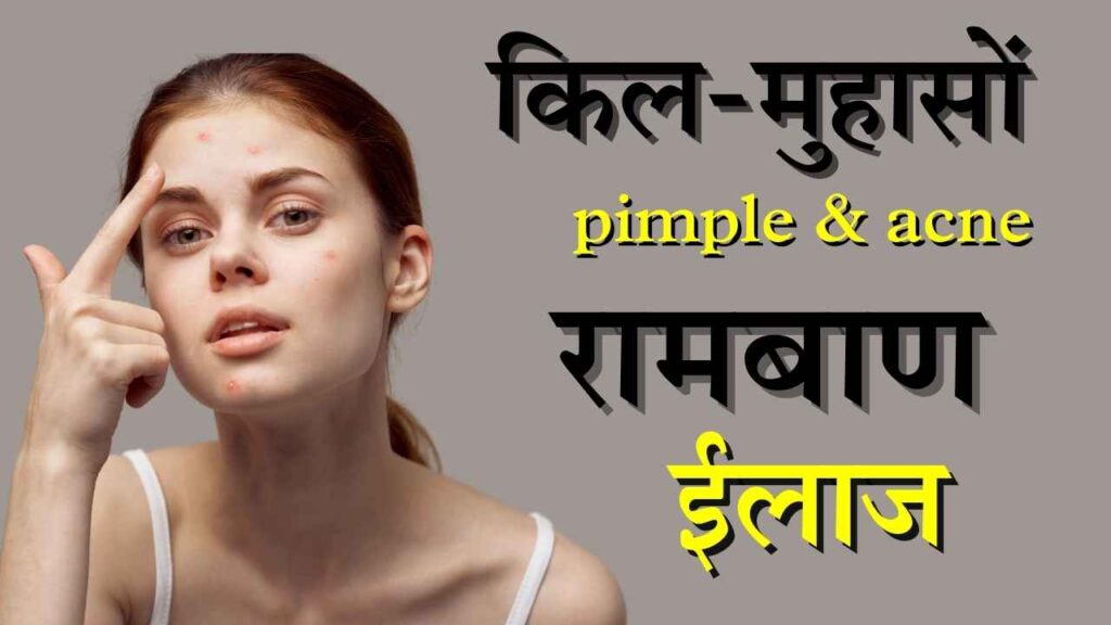 कील-मुंहासों का रामबाण इलाज